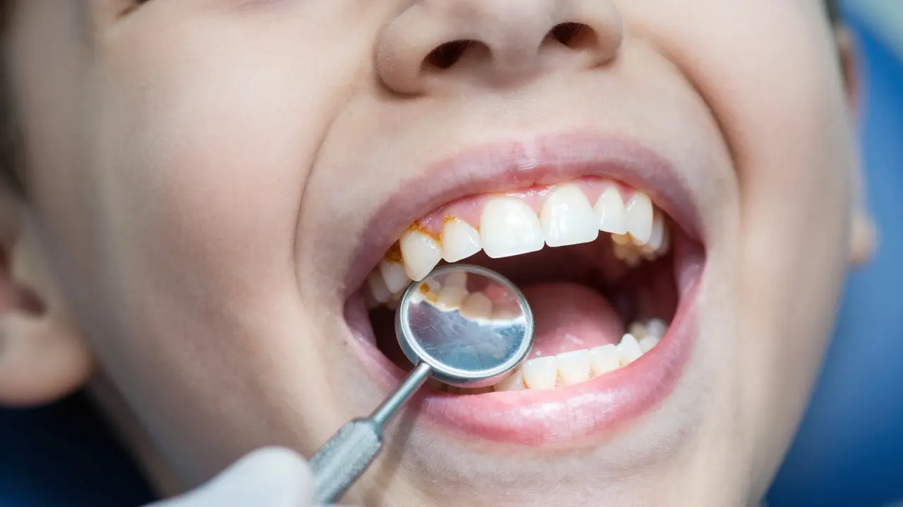 Proč je důležité řešit problém zubního kamene u dětí: Kompletní průvodce pro rodiče
