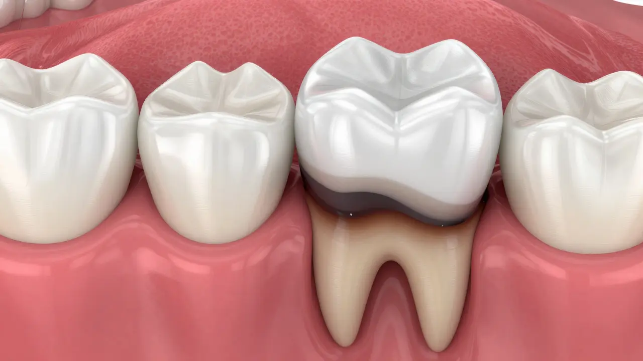 3D průřez zubu znázorňující sekundární kaz pod bílou plombou.