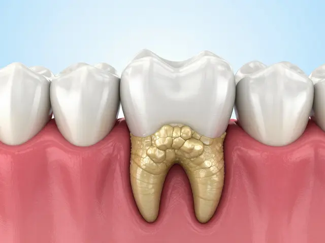 Zubní kámen pod dásní: Jak se ho zbavit a předejít jeho návratu